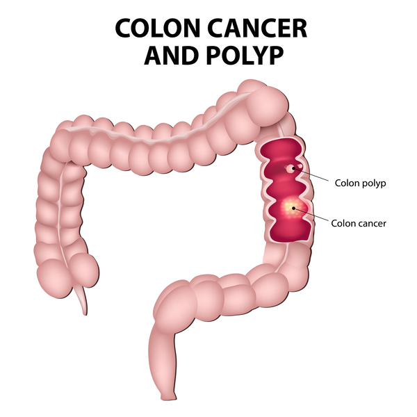 Colon Cancer and Colon Polyp